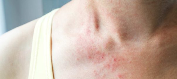 7 Nutrients for Itchy Skin